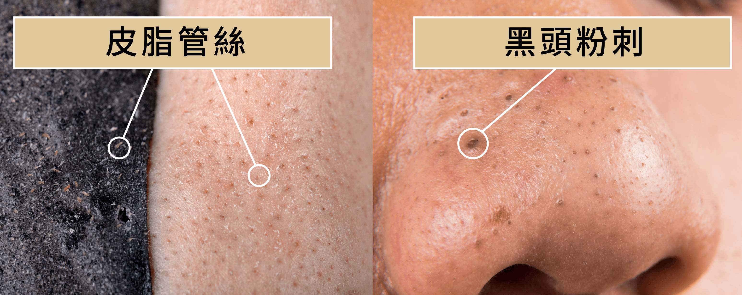 鼻子黑頭粉刺可以天天清嗎 越l Excellence 更多專業文章