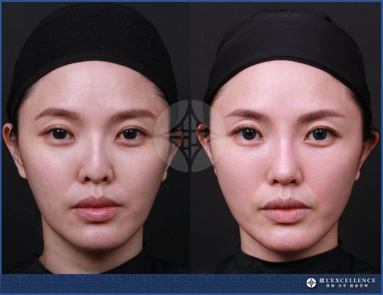 隆鼻手術有哪些?4大手術方法、3種注射微整方式全評比! - Lexcellence'越