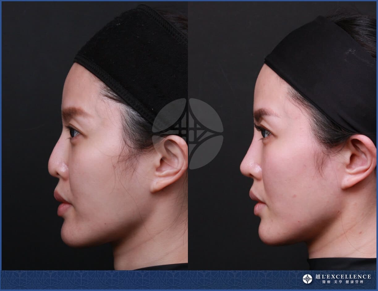 隆鼻手術有哪些?4大手術方法、3種注射微整方式全評比! - Lexcellence'越