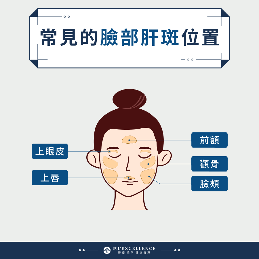常見的臉部肝斑位置：顴骨、前額、上眼皮、上唇、臉頰