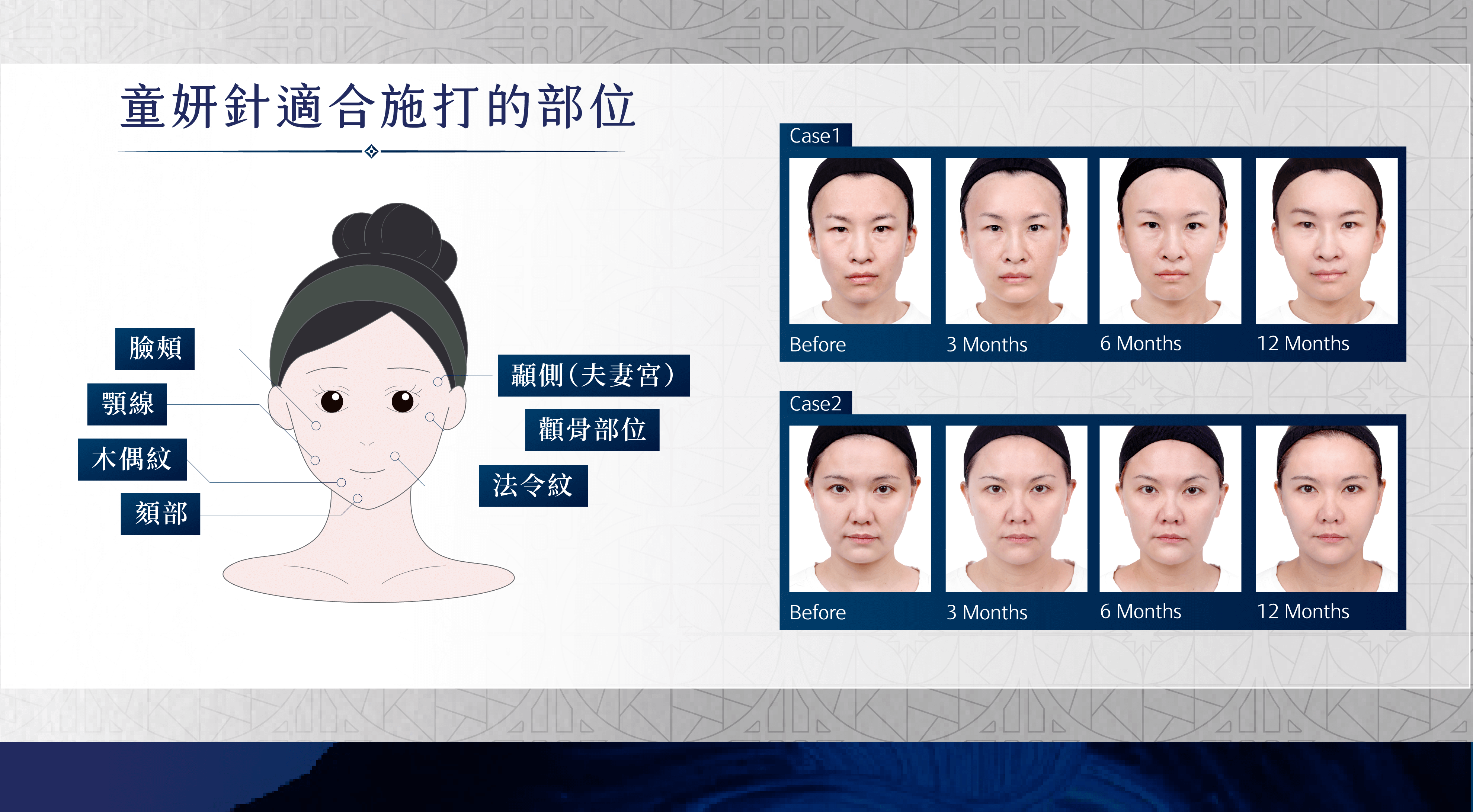 童顏針施打部位介紹圖