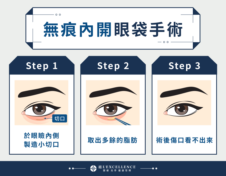 無痕內開眼袋手術