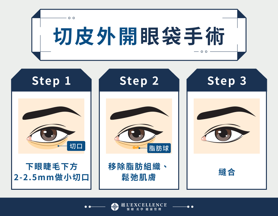 切皮外開眼袋手術