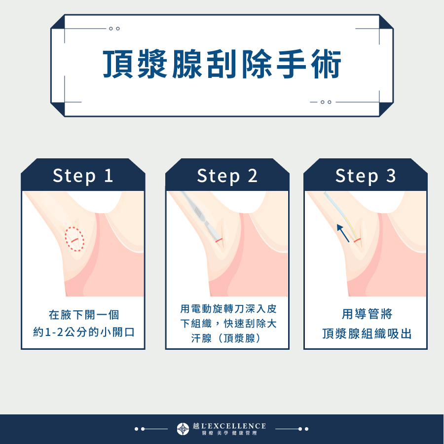 頂漿腺刮除手術