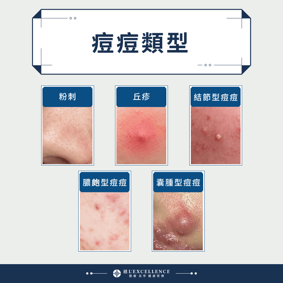 痘痘一直長怎麼辦?醫師分享有效消痘痘的治療方法!