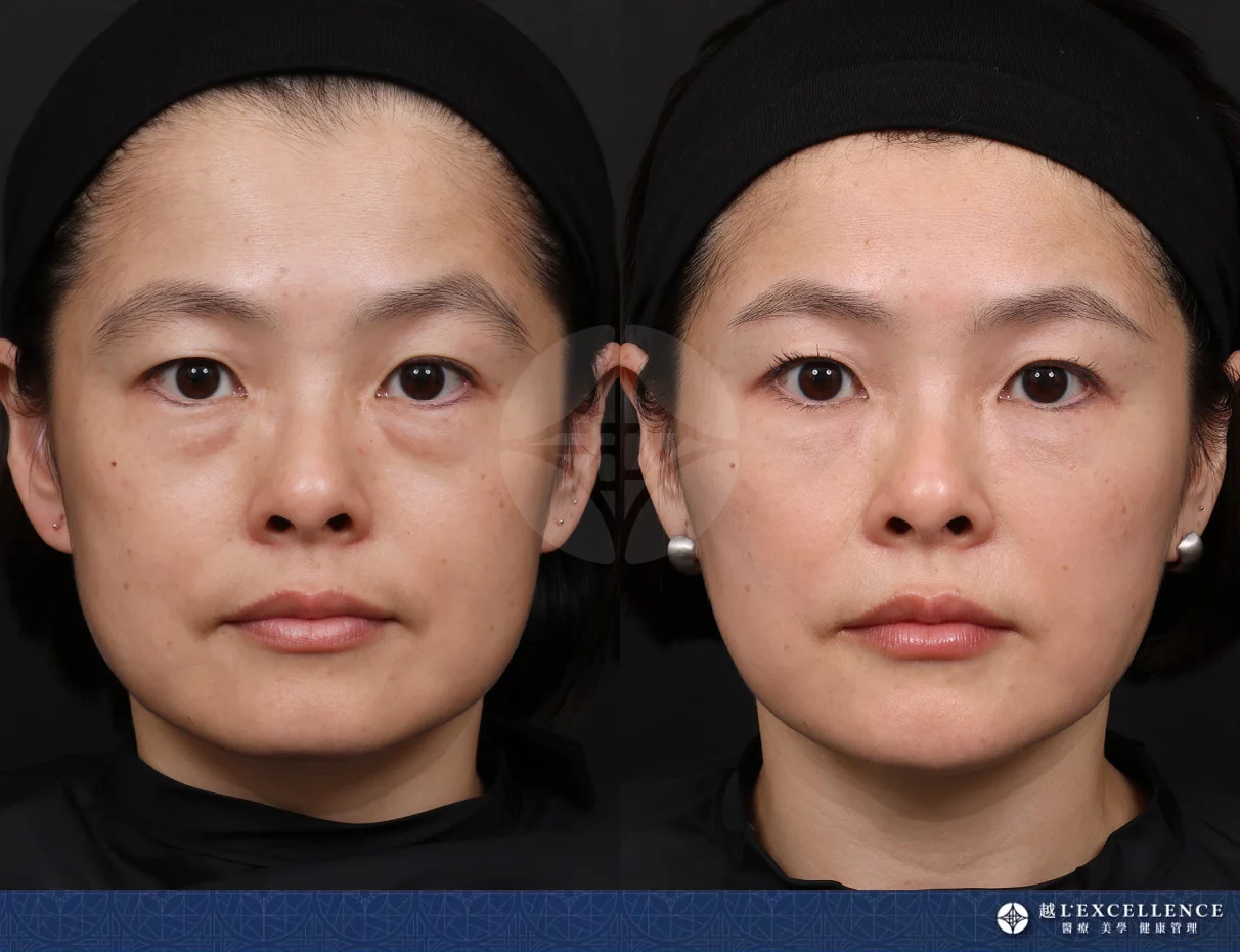 越診所 10232全臉玻尿酸 正