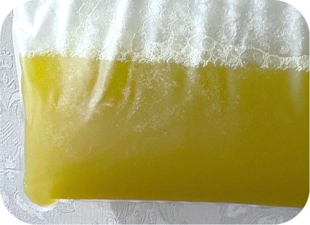 MCS+ 血液淨化治療結果 藥物累積 三酸甘油脂異常