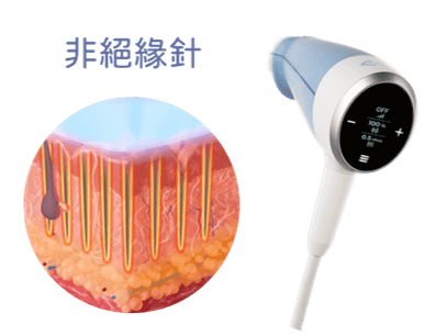 EXION時空E電波非絕緣針作用原理｜越診所越境診所