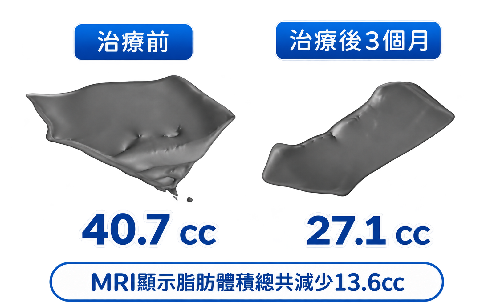 EMFACE 下巴專用探頭治療前後脂肪體積MRI研究比較