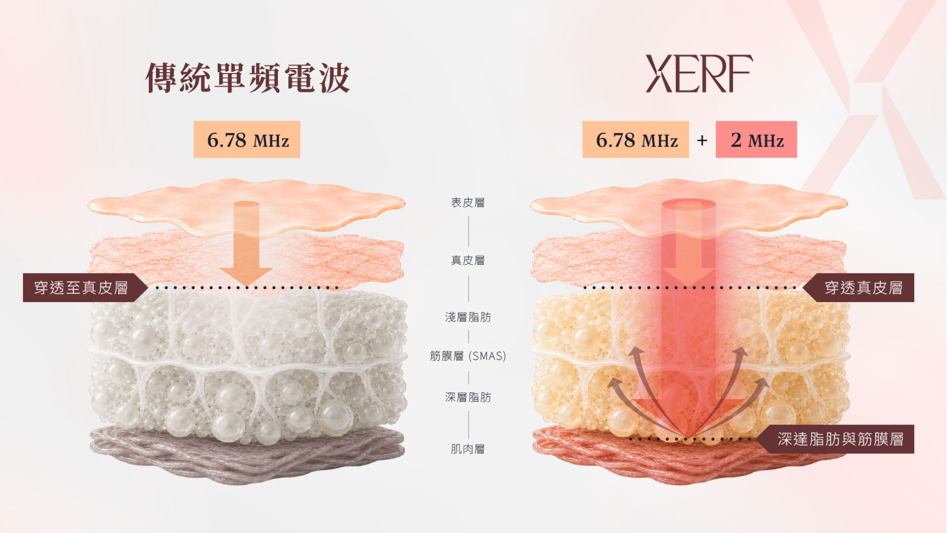 XERF雙頻電波6.78MHz與2MHz作用原理